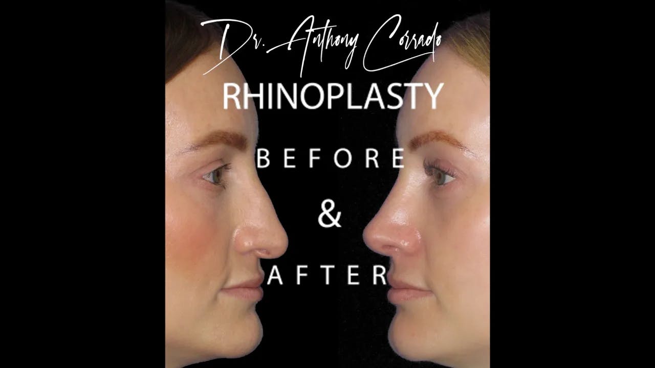 Flawless Nose Transformation: Stunning Rhinoplasty Before & After Results