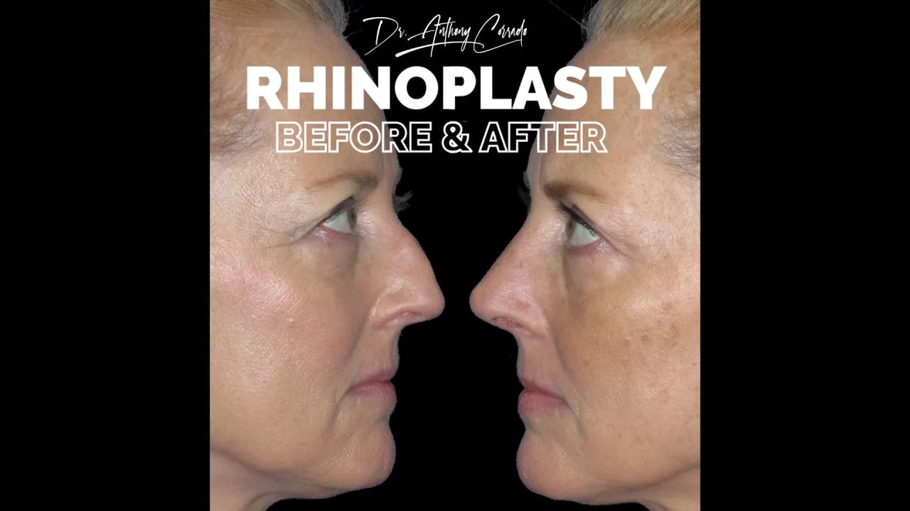 Female Rhinoplasty Before & After: Nasal Asymmetry & Dorsal Hump Corrected