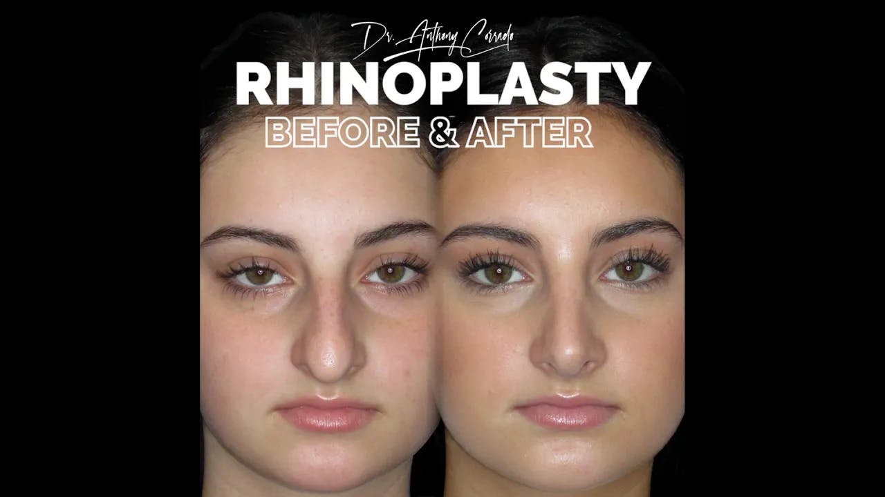 Female Rhinoplasty Before & After: Bulbous Tip, Dorsal Hump & Droopy Tip Refined