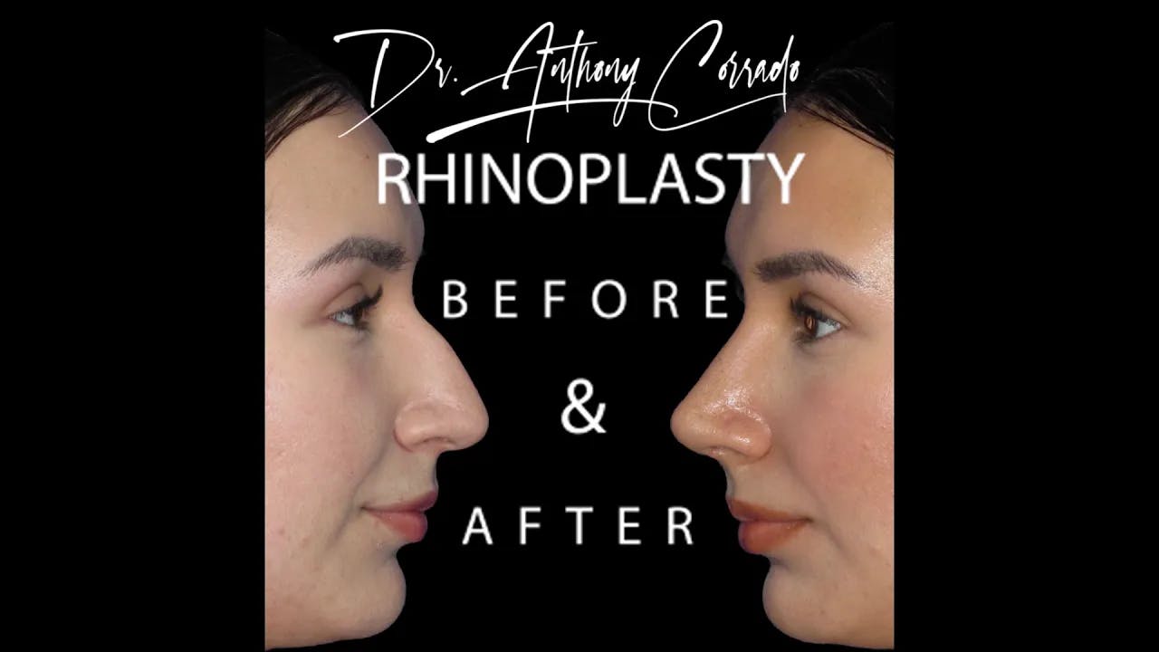 Female Rhinoplasty Before & After: Dorsal Hump, Wide Tip & Plunging Tip Corrected