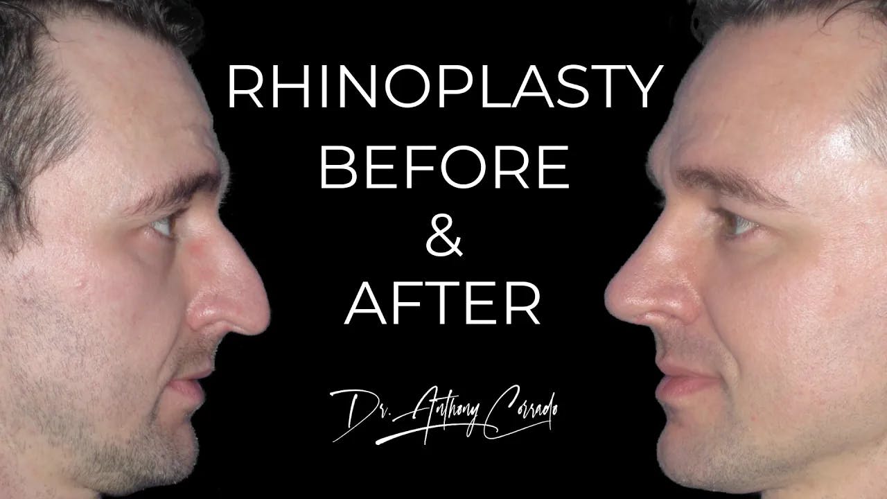 Male Rhinoplasty Before & After: Dorsal Hump & Droopy Tip Corrected