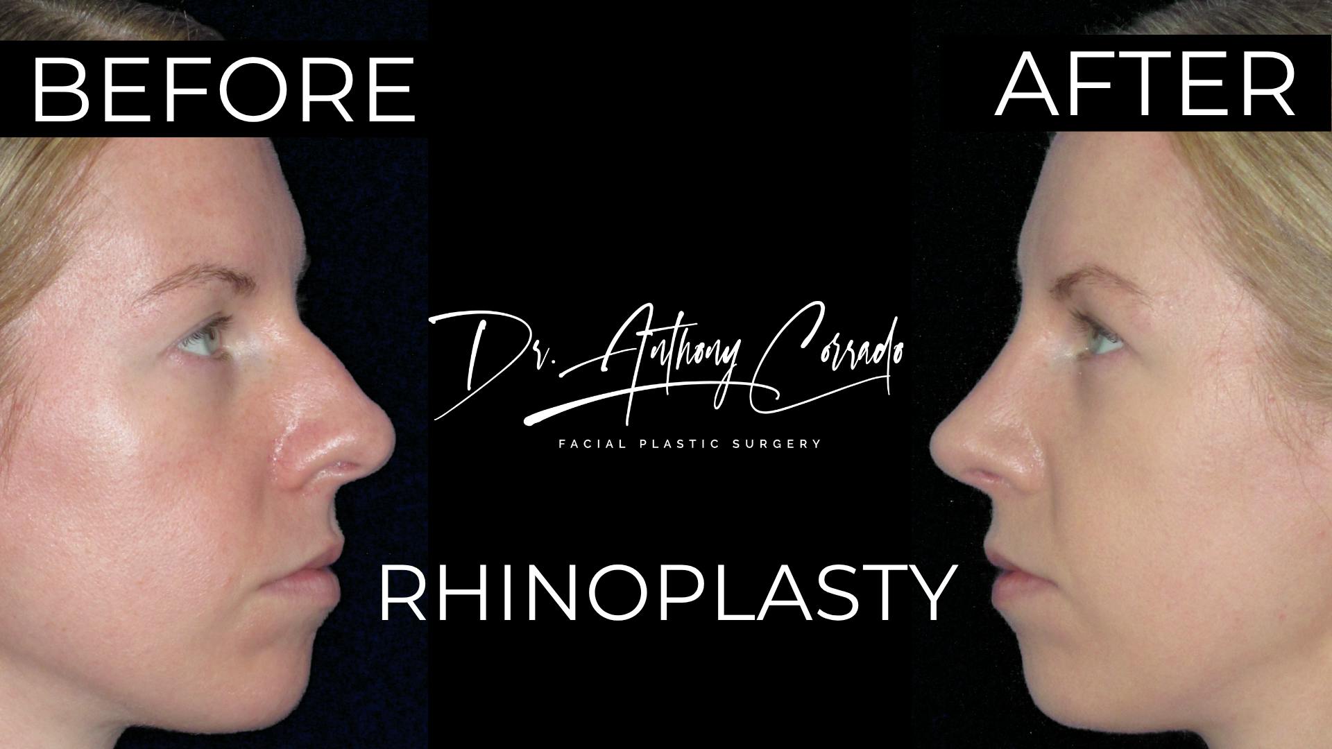 Flawless Before & After Rhinoplasty Transformation