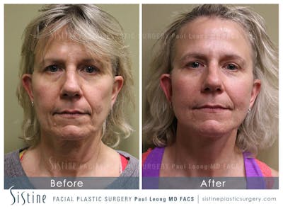 Facelift Before & After Gallery - Patient 4883637 - Image 1