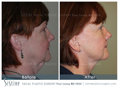 Facelift Before & After Gallery - Patient 4883638 - Image 4