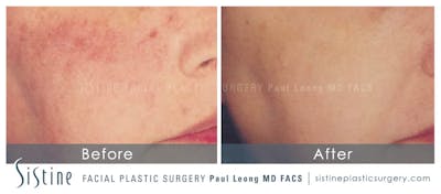 Photofacial Before & After Gallery - Patient 4883738 - Image 1