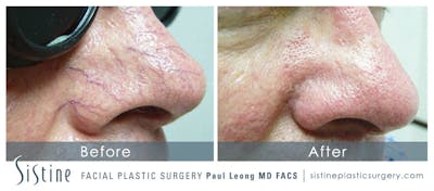 Photofacial Before & After Gallery - Patient 4883740 - Image 1