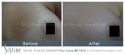 Stretch Marks Before & After Gallery - Patient 4883745 - Image 1