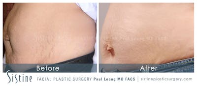Stretch Marks Before & After Gallery - Patient 4883746 - Image 1