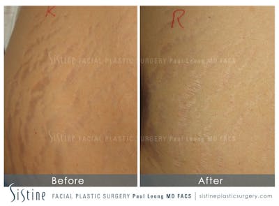 Stretch Marks Before & After Gallery - Patient 4883747 - Image 1