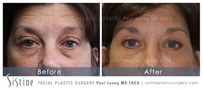 Ultherapy™ Before & After Gallery - Patient 4883751 - Image 1