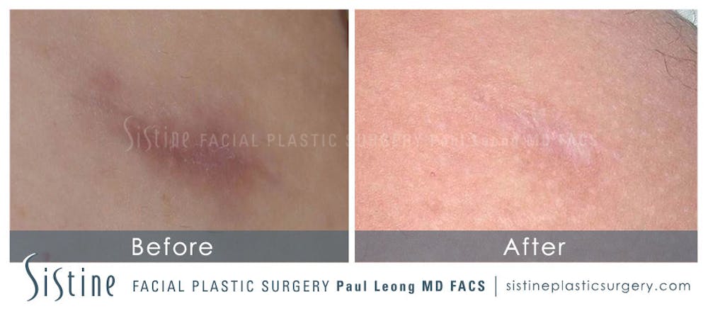 Scar/Wrinkle Removal Gallery - Patient 4883758 - Image 1