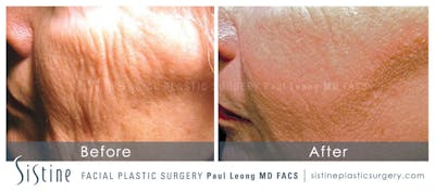 Scar/Wrinkle Removal Before & After Gallery - Patient 4883759 - Image 1