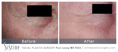 Scar/Wrinkle Removal Before & After Gallery - Patient 4883760 - Image 1