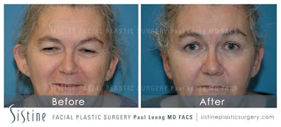 Otoplasty Before & After Gallery - Patient 4883775 - Image 1