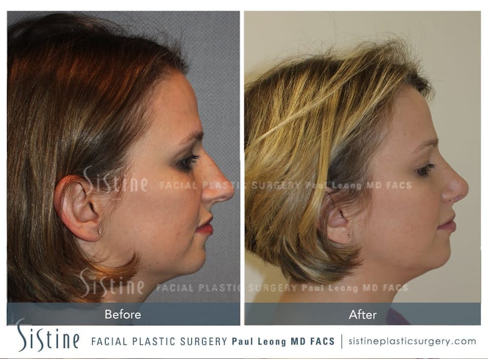 Rhinoplasty Before & After Gallery - Patient 4883787 - Image 2