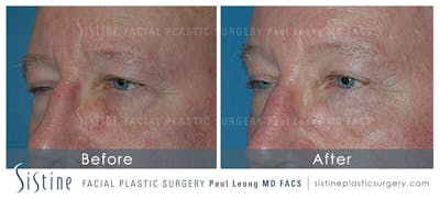 Browlift Before & After Gallery - Patient 4883793 - Image 1