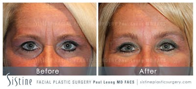Brow and Forehead Before & After Gallery - Patient 4883799 - Image 1