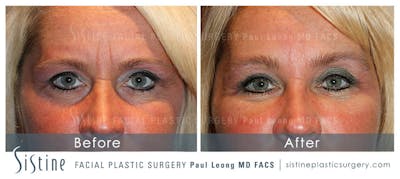 Brow and Forehead Before & After Gallery - Patient 4883803 - Image 1