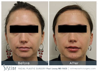 Brow and Forehead Before & After Gallery - Patient 4883804 - Image 1