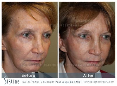 Cheeks Before & After Gallery - Patient 4883805 - Image 2