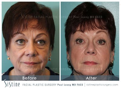 Cheeks Before & After Gallery - Patient 4883806 - Image 1