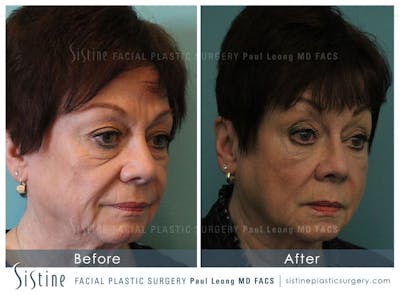 Cheeks Before & After Gallery - Patient 4883806 - Image 2