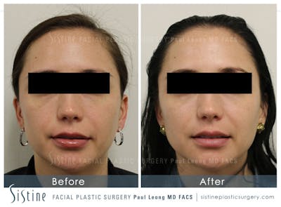 Cheeks Before & After Gallery - Patient 4883812 - Image 2