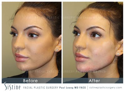 Chin, Jaw and Neck Before & After Gallery - Patient 4884544 - Image 1