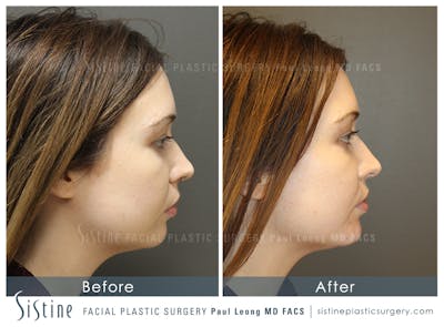 Chin, Jaw and Neck Before & After Gallery - Patient 4884540 - Image 1