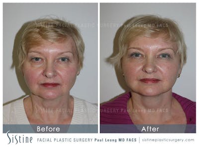 Eyes Before & After Gallery - Patient 4889668 - Image 1