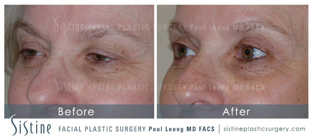 Eyes Before & After Gallery - Patient 4889684 - Image 1