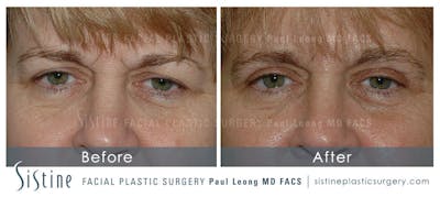 Eyes Before & After Gallery - Patient 4889742 - Image 1