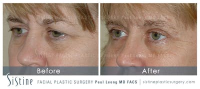 Eyes Before & After Gallery - Patient 4889742 - Image 2