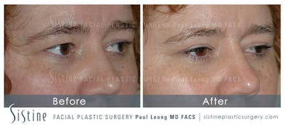 Eyes Before & After Gallery - Patient 4889743 - Image 1