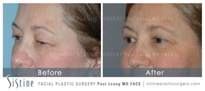 Eyes Before & After Gallery - Patient 4889744 - Image 2