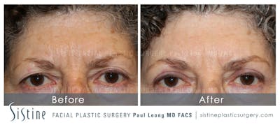 Eyes Before & After Gallery - Patient 4889806 - Image 1