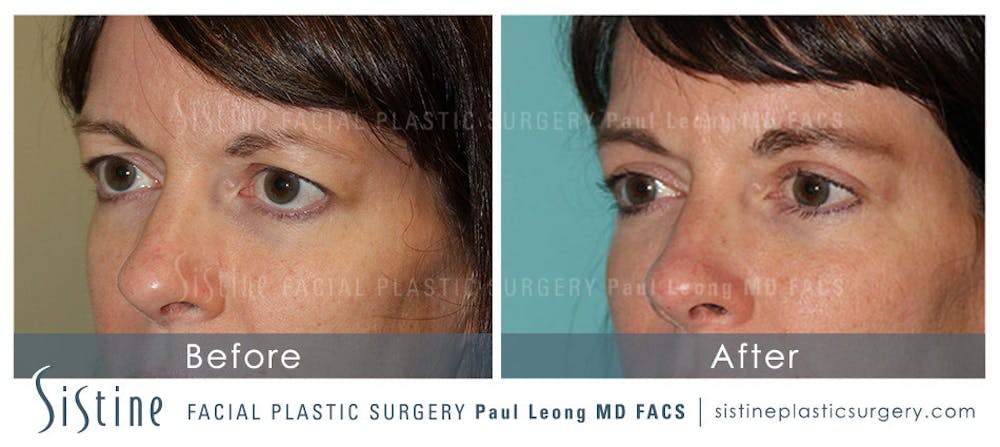 Eyes Before & After Gallery - Patient 4889809 - Image 2