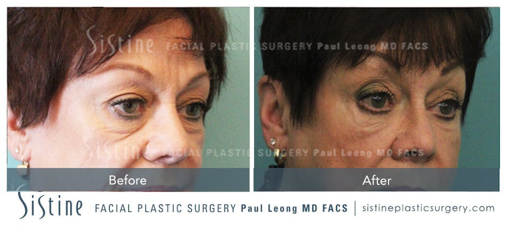 Eyes Before & After Gallery - Patient 4889838 - Image 2