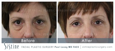 Eyes Before & After Gallery - Patient 4889854 - Image 1