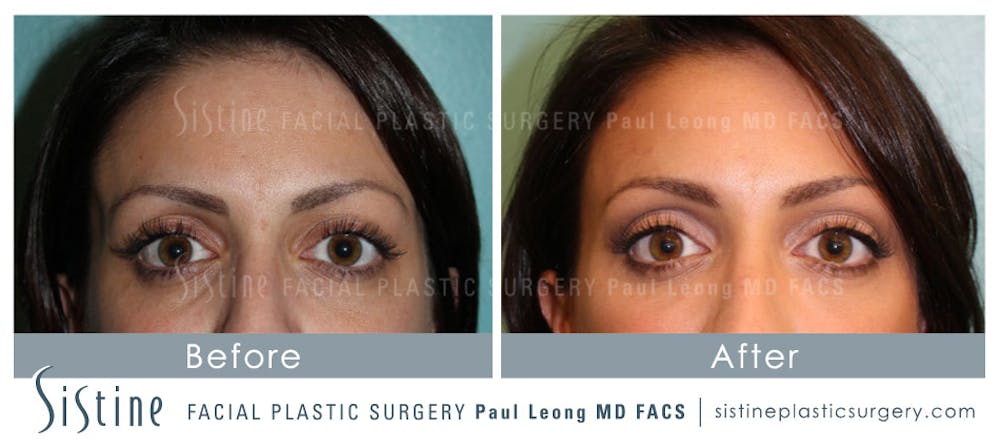 Eyes Before & After Gallery - Patient 4889908 - Image 1