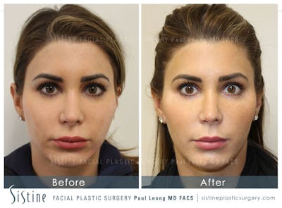 Masseter Before & After Gallery - Patient 4889939 - Image 1