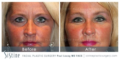 Nasolabial Folds Before & After Gallery - Patient 4889943 - Image 1
