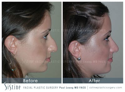 Nose Before & After Gallery - Patient 4889950 - Image 1