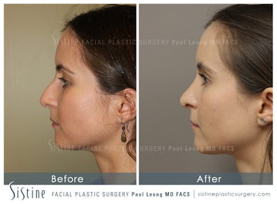 Nose Before & After Gallery - Patient 4889969 - Image 1