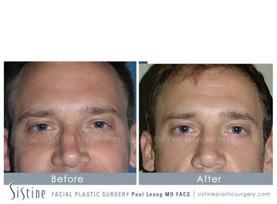 Nose Before & After Gallery - Patient 4890034 - Image 1