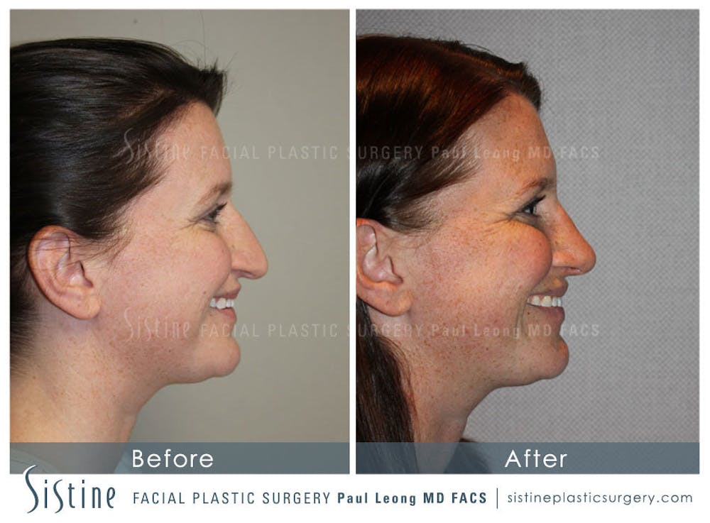 Nose Before & After Gallery - Patient 4890078 - Image 6