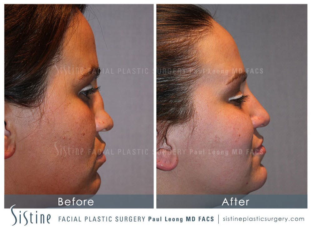 Nose Before & After Gallery - Patient 4890081 - Image 4