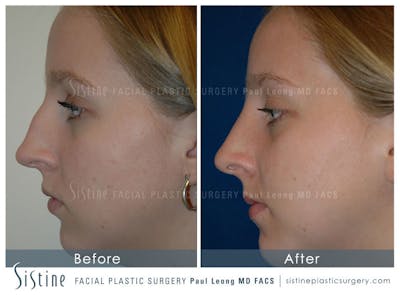 Nose Before & After Gallery - Patient 4890084 - Image 1