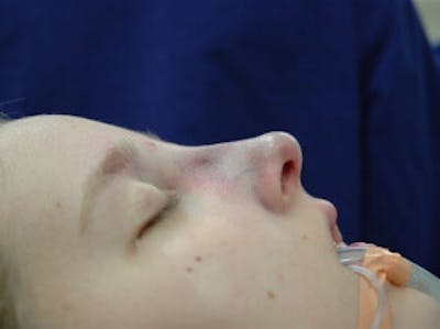 Nose Gallery - Patient 4890084 - Image 4