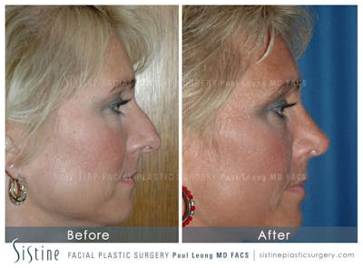 Nose Before & After Gallery - Patient 4890111 - Image 4